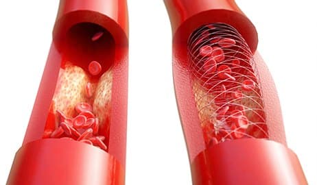 A drug-eluting stent restoring blood flow in a plaque-narrowed artery.